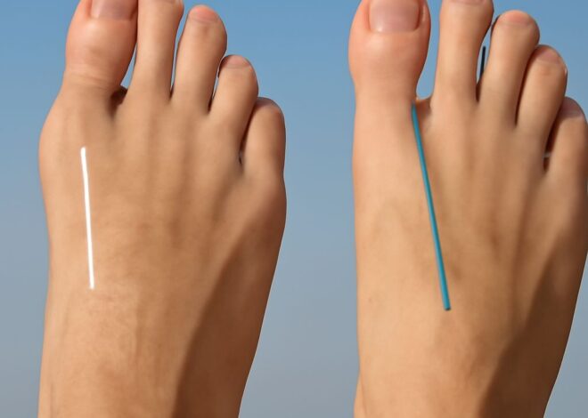 How to Shrink Bunions Naturally: Effective Home Remedies